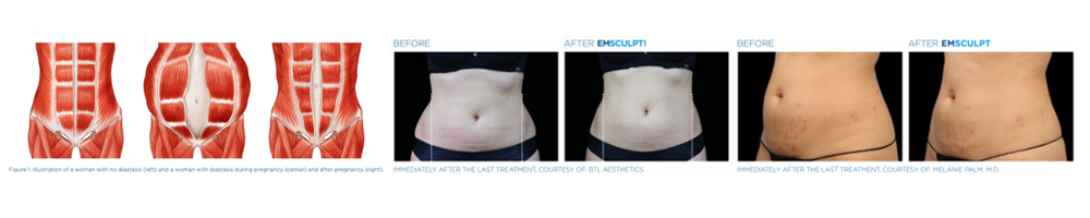 Postpartum & Diastasis Recti Recovery | Before & After
